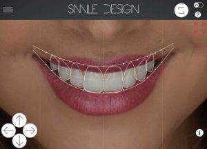Qué es el Digital Smile Design