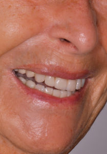 Caso odontología rehabilitadora Jurado