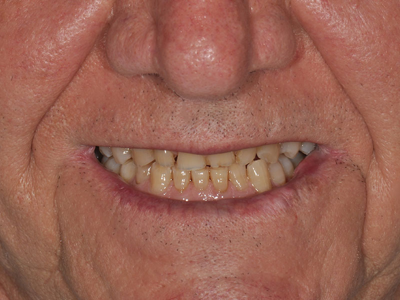 Caso odontología rehabilitadora Recatalá
