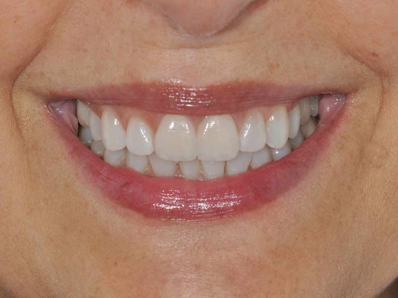 Principales Tratamientos de estética dental